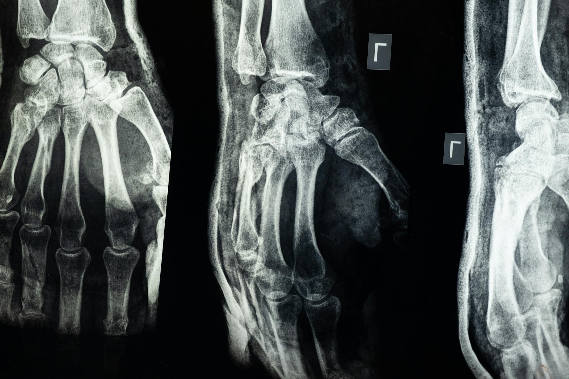 10 Common Facts About Open Fracture Everyone Should Know
