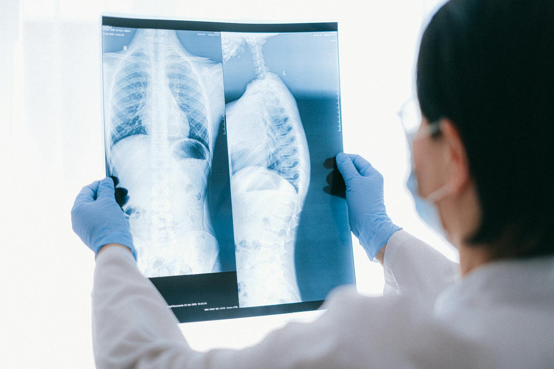 10 Surprising Tuberculosis Causes and Risk Factors You Should Know